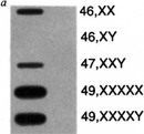 这个槽污点显示不同强度的乐队代表的相对数量Xist总RNA的RNA样品准备从几细胞系。有一个乐队代表Xist表达在正常(46,XX)女性,但没有乐队在正常男性(46,XY)。47 Xist强度表达式,分别是XXY, 49, XXXXX, 49, XXXXY非整倍性细胞系额外X染色体的数目成正比。乐队在47那么激烈,XXY 46, XX但在49更强烈,XXXXX和49,XXXXY。